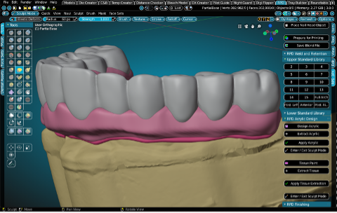 Flexibility in CAD/CAM Denture Design | Inside Dental Technology